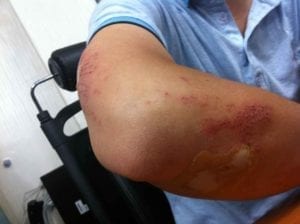 Scabs on hand